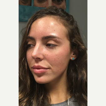 25-34 year old woman treated with Lip Augmentation after 3769690