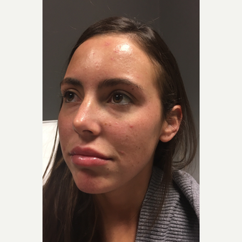 25-34 year old woman treated with Lip Augmentation before 3769690
