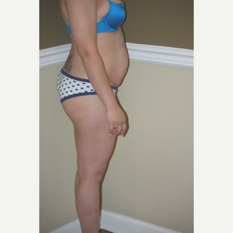 35-44 year old woman treated with Tummy Tuck before 2721364