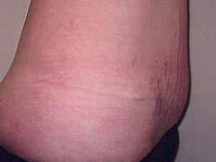 Tummy Tuck 1075071