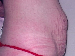 Tummy Tuck 1075071
