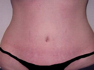 Tummy Tuck after 1075071