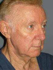 LiteLift™ and Brow Lift on 68-Year-Old Man 1149656
