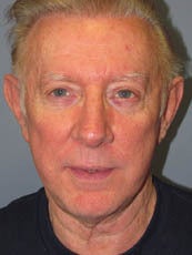 LiteLift™ and Brow Lift on 68-Year-Old Man after 1149656