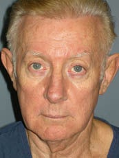LiteLift™ and Brow Lift on 68-Year-Old Man before 1149656