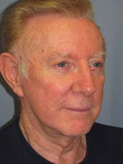 LiteLift™ and Brow Lift on 68-Year-Old Man 1149656