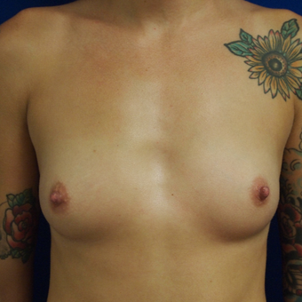 25-34 year old woman treated with Breast Augmentation before 3365754