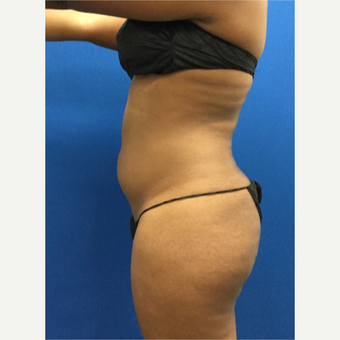 25-34 year old woman treated with Laser Liposuction before 3142108
