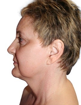 53 year old woman treated with open neck lift before 2870085