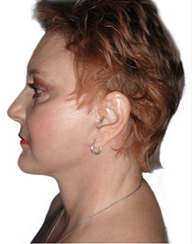 53 year old woman treated with open neck lift after 2870085