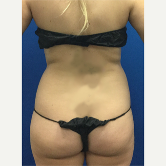 25-34 year old woman treated with Laser Liposuction before 3696914