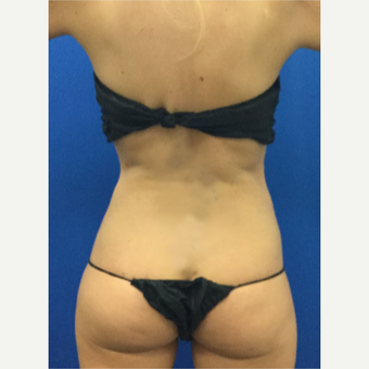 25-34 year old woman treated with Laser Liposuction after 3696914