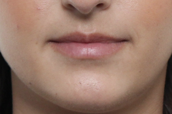 18-24 year old woman treated with Lip Augmentation before 3076190