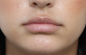 18-24 year old woman treated with Lip Augmentation after 3076190