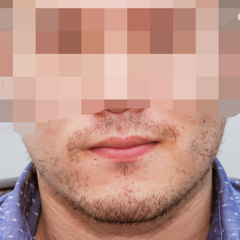 25-34 year old man treated with ARTAS Robotic Hair Transplant before 3300395