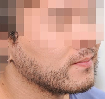 25-34 year old man treated with ARTAS Robotic Hair Transplant 3300395