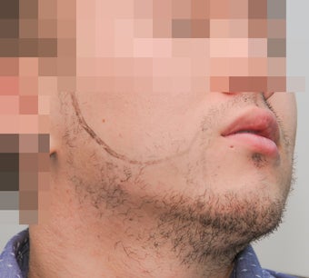 25-34 year old man treated with ARTAS Robotic Hair Transplant 3300395
