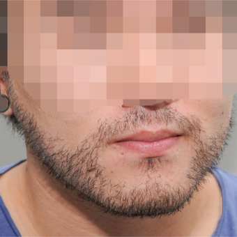 25-34 year old man treated with ARTAS Robotic Hair Transplant after 3300395