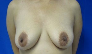 Breast Lift before 3055056