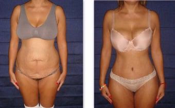 35 year old woman treated with Tummy Tuck before 3726810