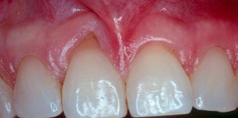 Gum Graft before 515405