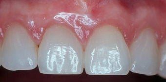 Gum Graft after 515405