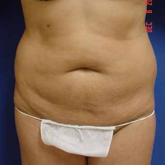 35-44 year old woman treated with Tummy Tuck before 3289235
