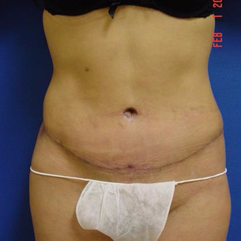 35-44 year old woman treated with Tummy Tuck after 3289235
