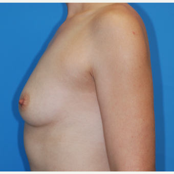 25-34 year old woman treated with Breast Implants before 3459808