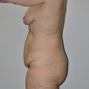45-54 year old woman treated with Body Lift 1828987