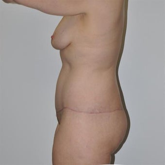 45-54 year old woman treated with Body Lift 1828987