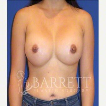 35-44 year old woman treated with Breast Augmentation after 3663559