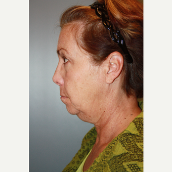 55-64 year old woman treated with Facelift before 3683627