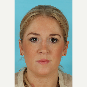 25-34 year old woman treated with Rhinoplasty after 3691175