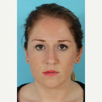 25-34 year old woman treated with Rhinoplasty before 3691175