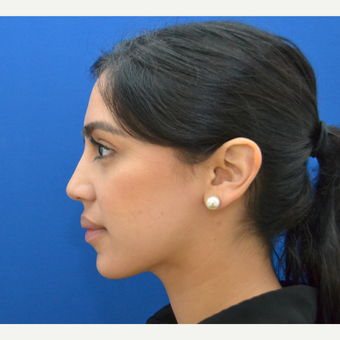 Buccal Fat Removal with Chin/Neck Liposculpting after 2791268
