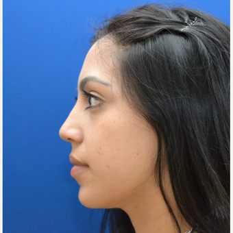 Buccal Fat Removal with Chin/Neck Liposculpting before 2791268