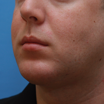 Young man treated with Chin Implant after 3383640