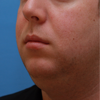 Young man treated with Chin Implant before 3383640