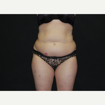 35-44 year old woman treated with Tummy Tuck before 3076455