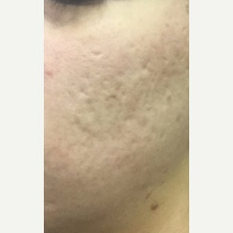 25-34 year old woman treated with CO2 Laser before 2081892