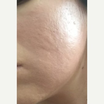 25-34 year old woman treated with CO2 Laser after 2081892