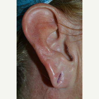 45-54 year old woman treated with Ear Lobe Surgery before 3424827