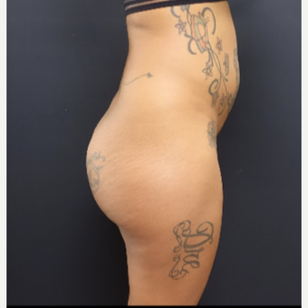 25-34 year old woman treated with Fat Transfer and 712cc Implants before 3129321