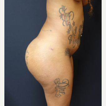 25-34 year old woman treated with Fat Transfer and 712cc Implants after 3129321
