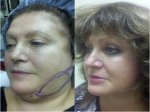 49 Year Old Before and After Laser Face Lift before 712595