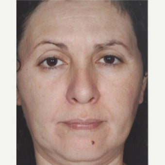 55-64 year old woman treated with Age Spots Treatment with Obagi Nu Derm Skin Transformation System after 2581707