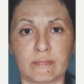 55-64 year old woman treated with Age Spots Treatment with Obagi Nu Derm Skin Transformation System before 2581707