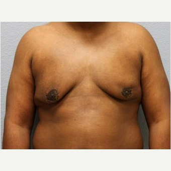 25-34 year old man treated with Male Breast Reduction after 3736951