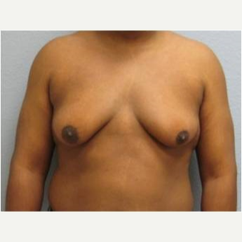 25-34 year old man treated with Male Breast Reduction before 3736951